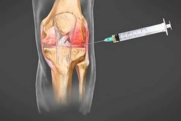 Хронический синовит сустава колена